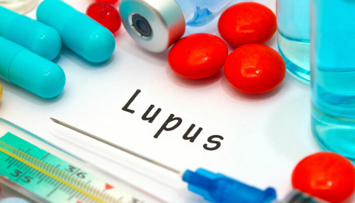 Lupus – Symptoms, Risk Factors, and Diagnosis
