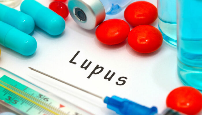Avoid These 12 Triggers to Manage Lupus