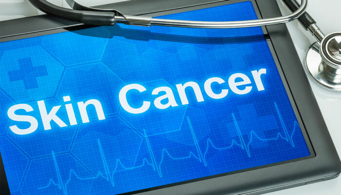 Skin cancer – Types and warning signs