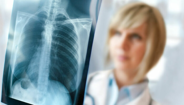 Types and early signs of lung cancer