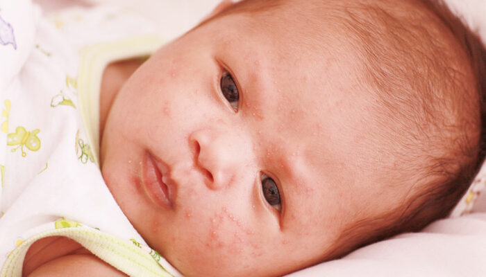 8 first-line treatments for atopic dermatitis in infants